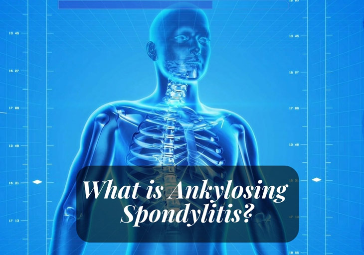 What is ankylosing spondylitis